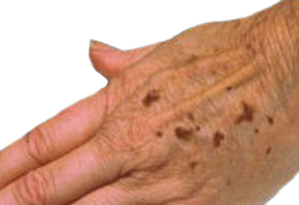 Age Spots On Hands