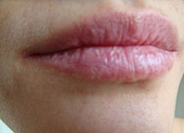 Dry Itchy Lips | Causes and Natural Home Remedies for ...