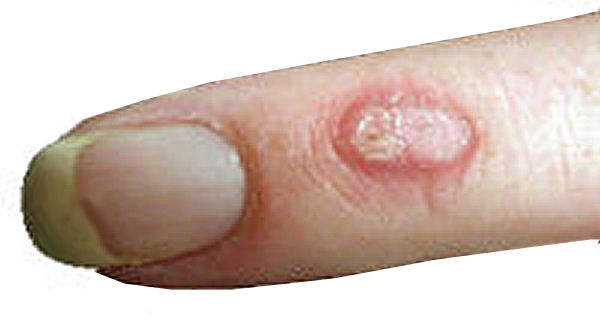 Seed Warts