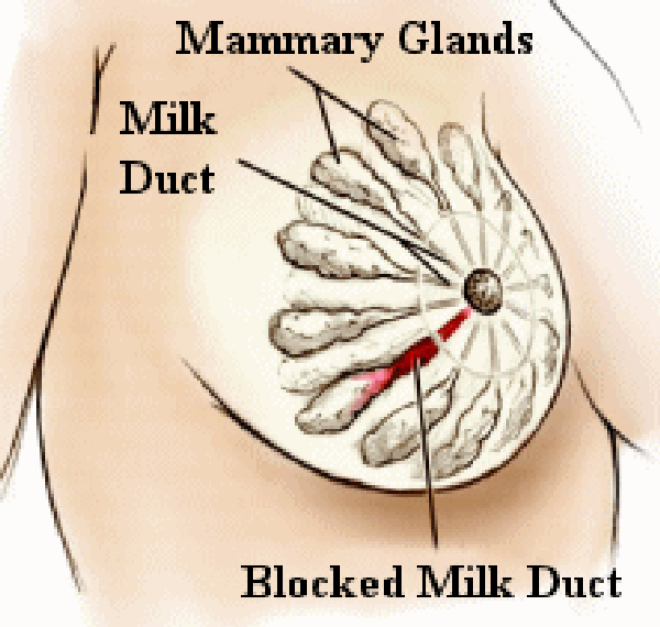 Blocked Milk Duct Home Remedy