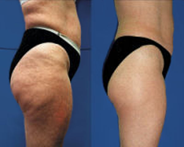 cellulite