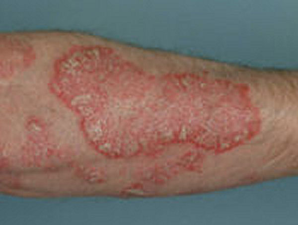 Psoriasis Home Remedy