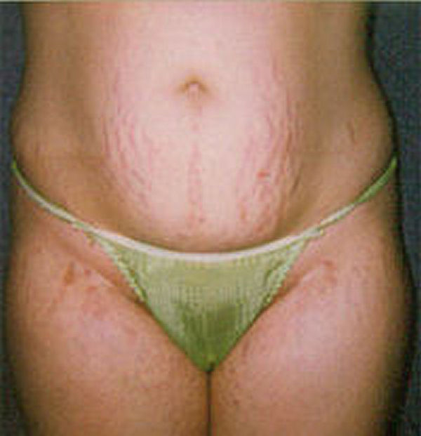 Stretch Marks Home Remedy