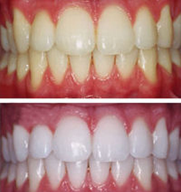Teeth Whitening Home Remedy