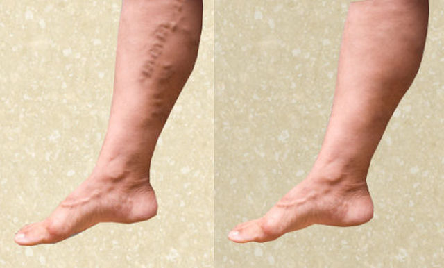 Home Remedies for Varicose Veins