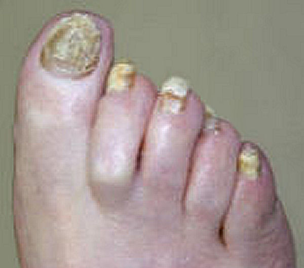 Nail Fungus Home Remedy