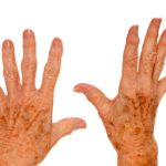 Age Spots Home Remedy