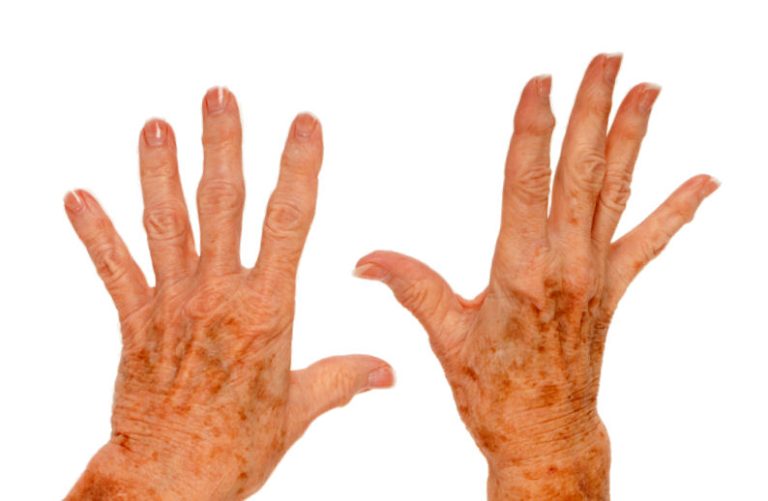 Age Spots Home Remedy