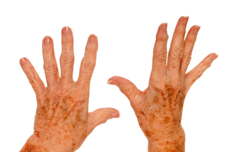 Age Spots Home Remedy