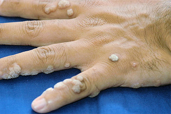 Warts Home Remedy