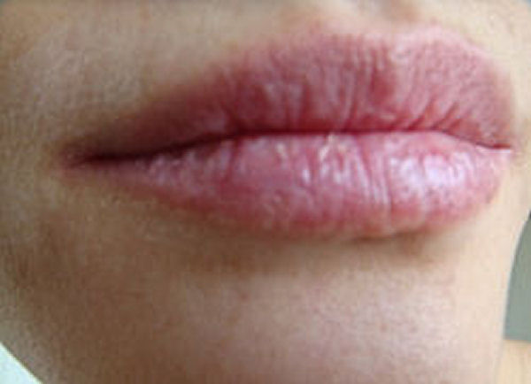 Chapped Lips Home Remedy
