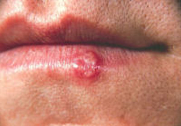 Cold Sores Home Remedy