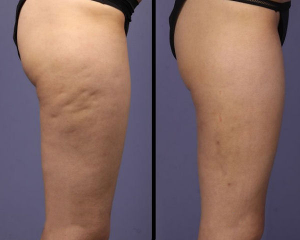 Cellulite Home Remedy
