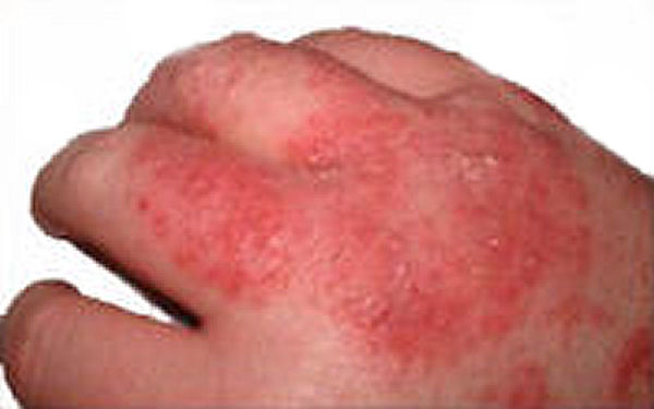 Eczema Home Remedy