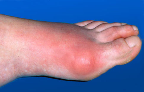 Gout Home Remedy