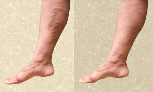 Home Remedies for Varicose Veins